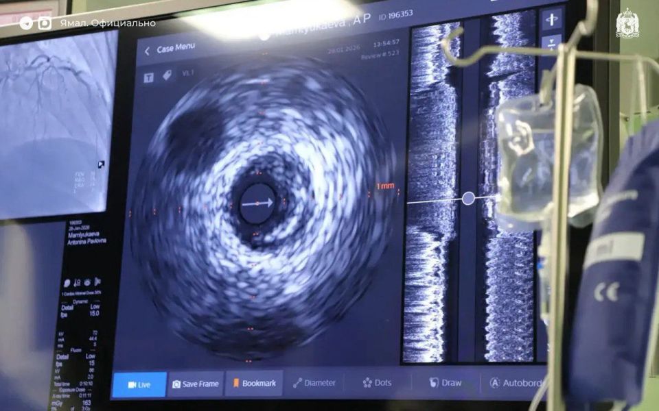 Врачи Ноябрьской больницы начали делать внутрисосудистое УЗИ