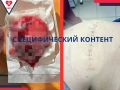 В Новом Уренгое хирурги удалили гигантскую липому размером 1510 см. Доброкачественное образование правого бедра диагностировали у 50-летнего мужчины