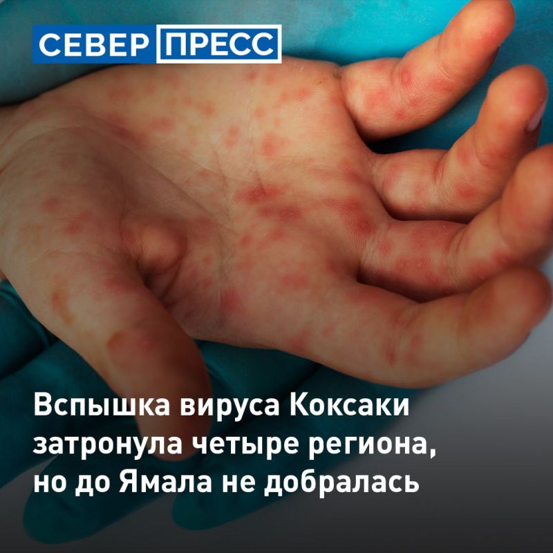 На Ямале случаев заражения вирусом Коксаки не зафиксировано